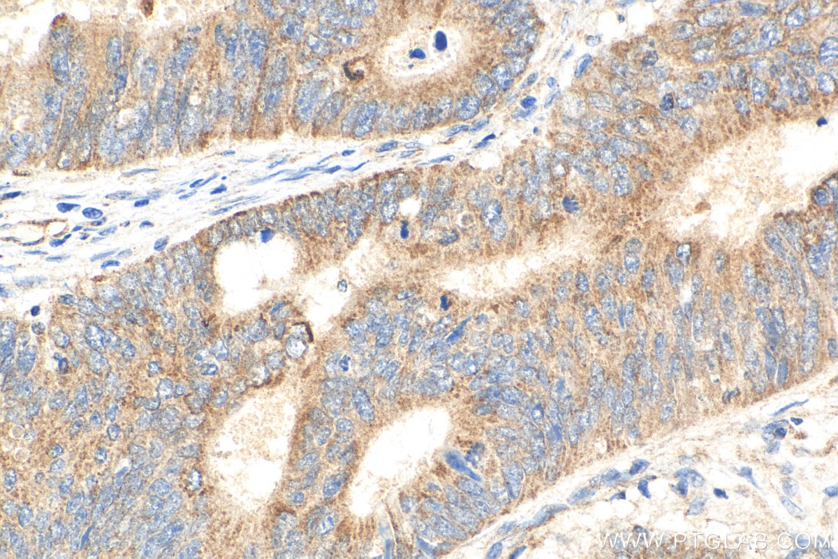 Immunohistochemistry (IHC) staining of human colon cancer tissue using COX19 Polyclonal antibody (31226-1-AP)