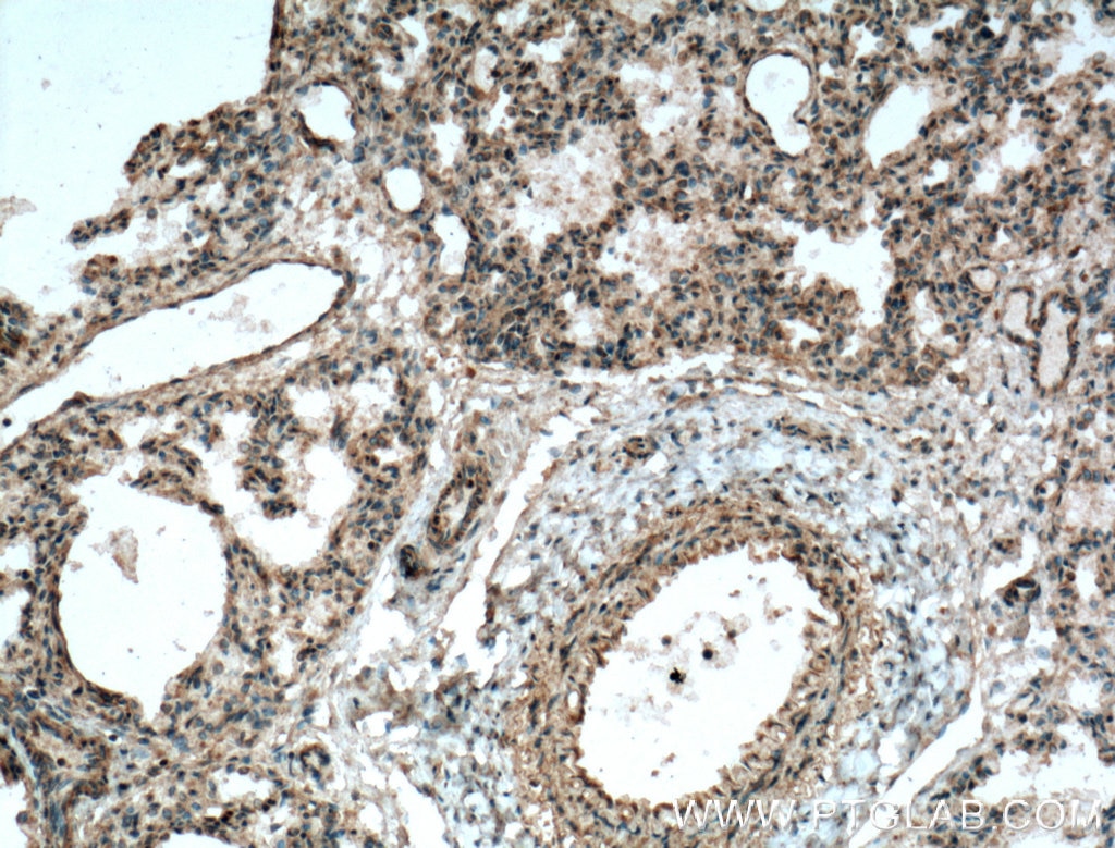 Immunohistochemistry (IHC) staining of human lung tissue using COX2/ Cyclooxygenase 2/ PTGS2 Polyclonal antibody (27308-1-AP)