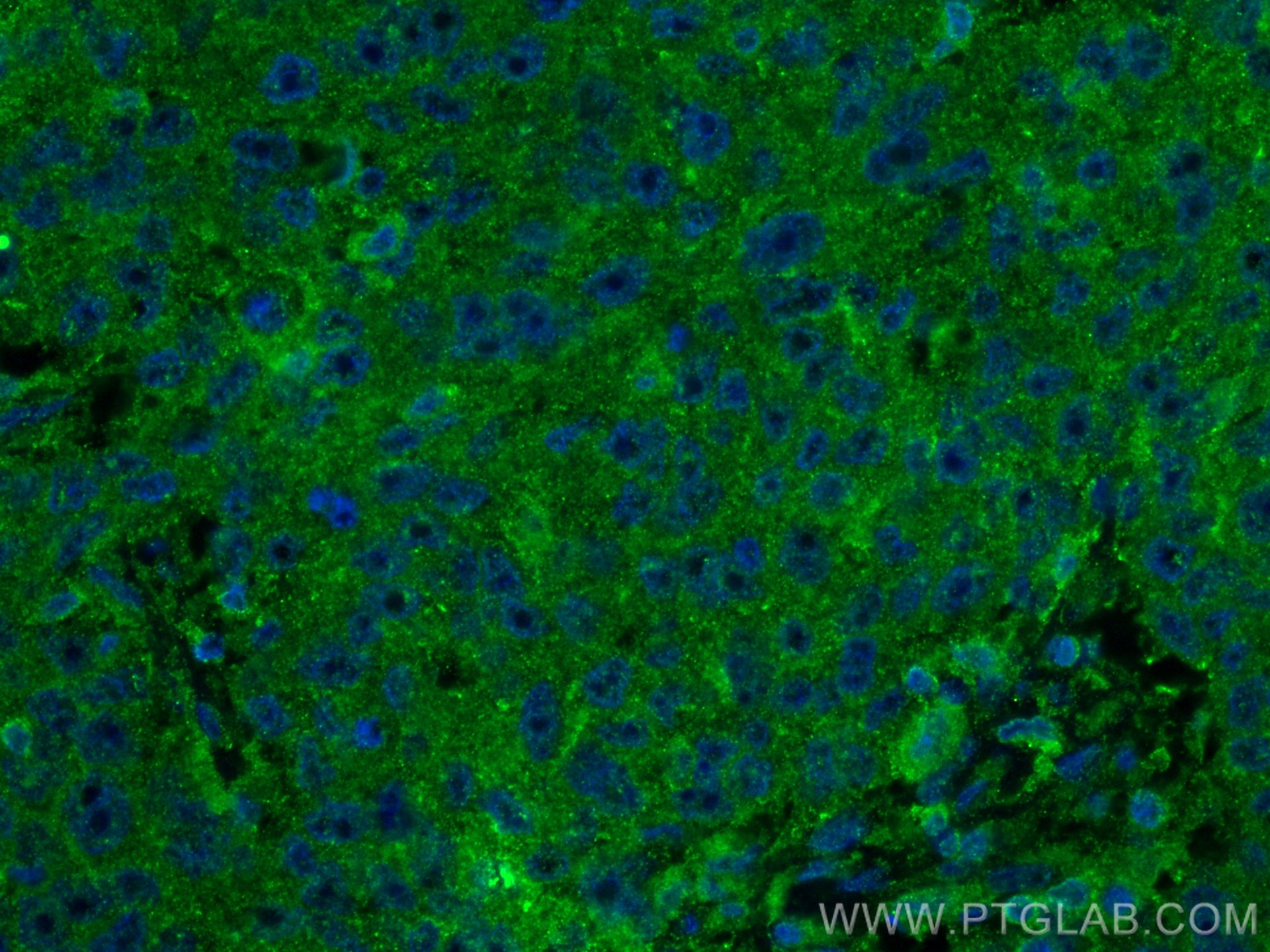 Immunofluorescence (IF) / fluorescent staining of human breast cancer tissue using COX2/ Cyclooxygenase 2/ PTGS2 Monoclonal antibody (66351-1-Ig)