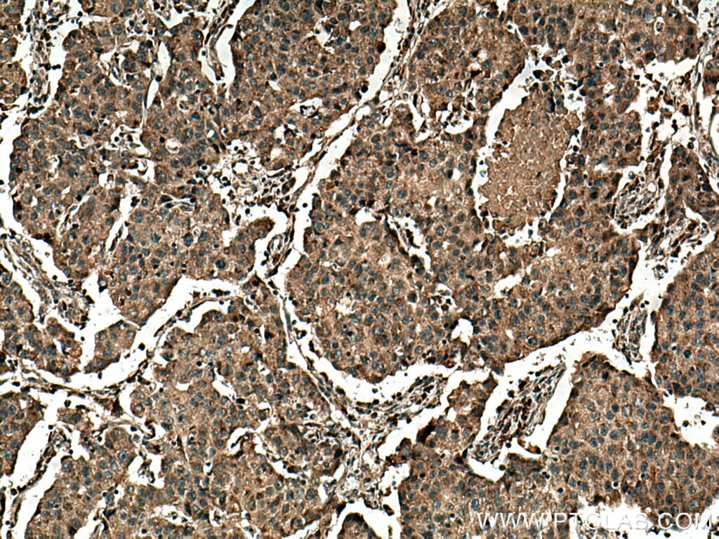 Immunohistochemistry (IHC) staining of human breast cancer tissue using COX2/ Cyclooxygenase 2/ PTGS2 Monoclonal antibody (66351-1-Ig)