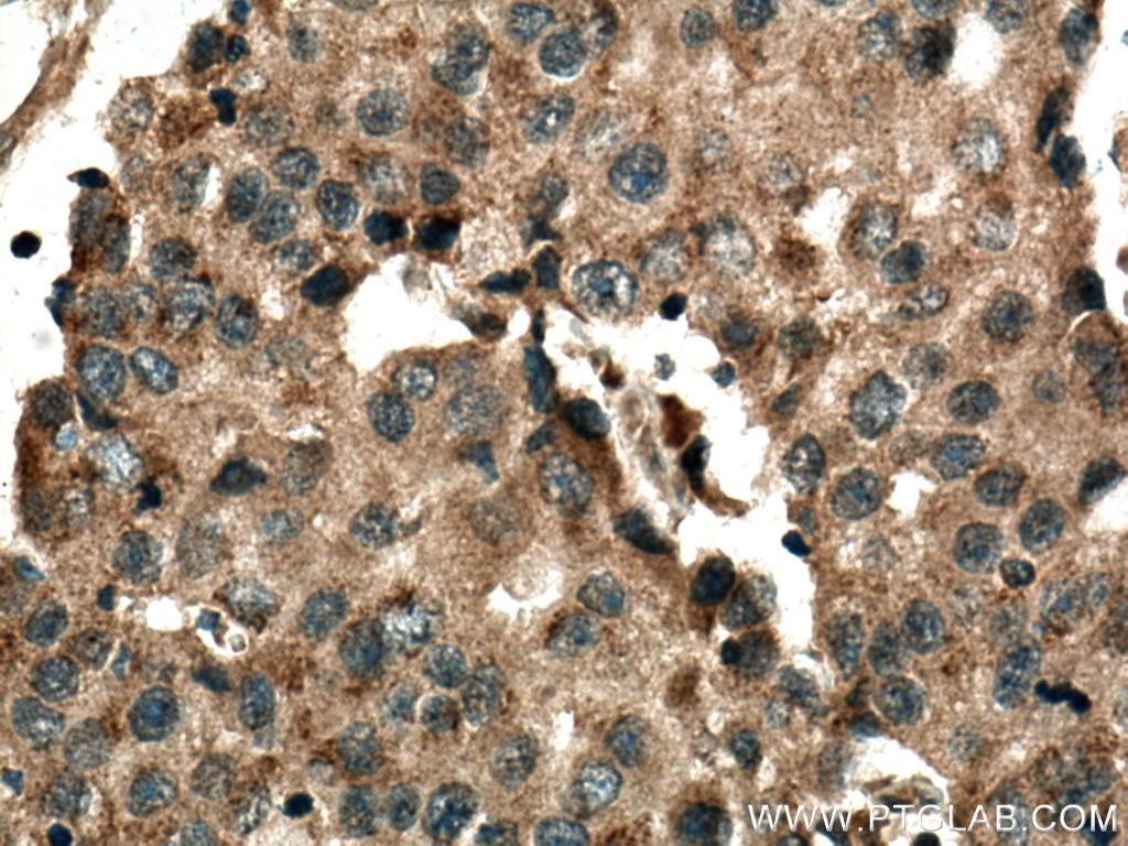 Immunohistochemistry (IHC) staining of human breast cancer tissue using COX2/ Cyclooxygenase 2/ PTGS2 Monoclonal antibody (66351-1-Ig)
