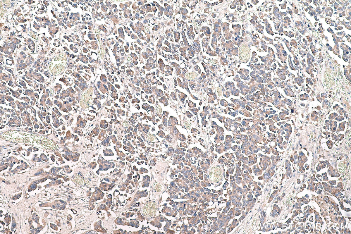 Immunohistochemistry (IHC) staining of human colon cancer tissue using COX2/ Cyclooxygenase 2/ PTGS2 Monoclonal antibody (66351-1-Ig)