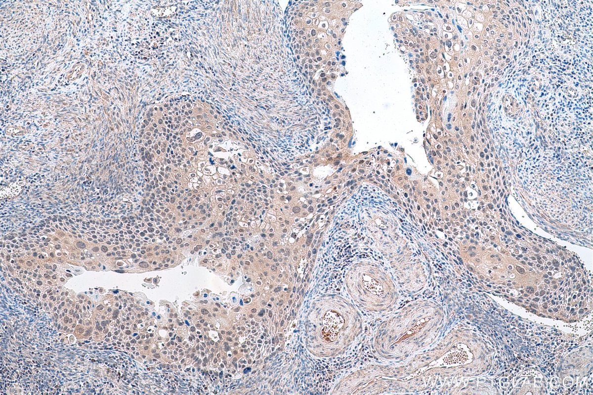 Immunohistochemistry (IHC) staining of human cervical cancer tissue using COX2/ Cyclooxygenase 2/ PTGS2 Monoclonal antibody (66351-1-Ig)