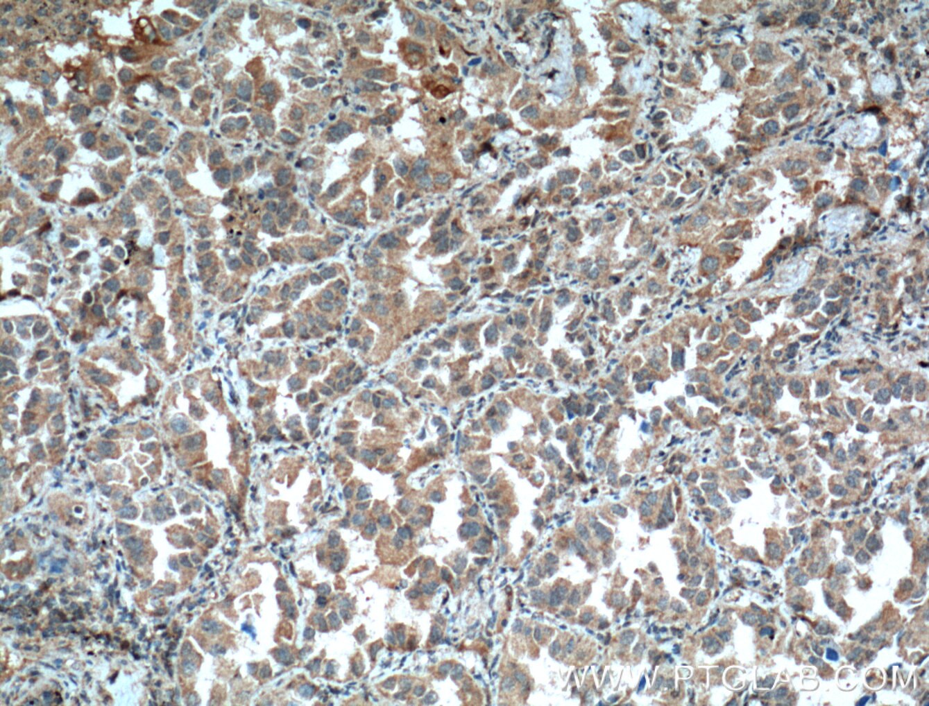 Immunohistochemistry (IHC) staining of human lung cancer tissue using COX2/ Cyclooxygenase 2/ PTGS2 Monoclonal antibody (66351-1-Ig)