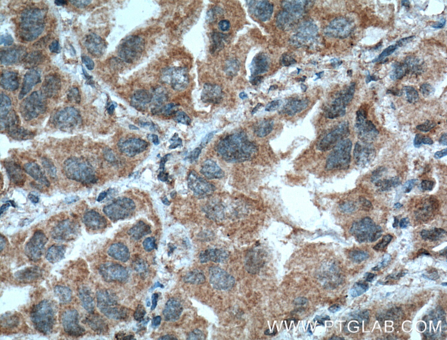 Immunohistochemistry (IHC) staining of human lung cancer tissue using COX2/ Cyclooxygenase 2/ PTGS2 Monoclonal antibody (66351-1-Ig)
