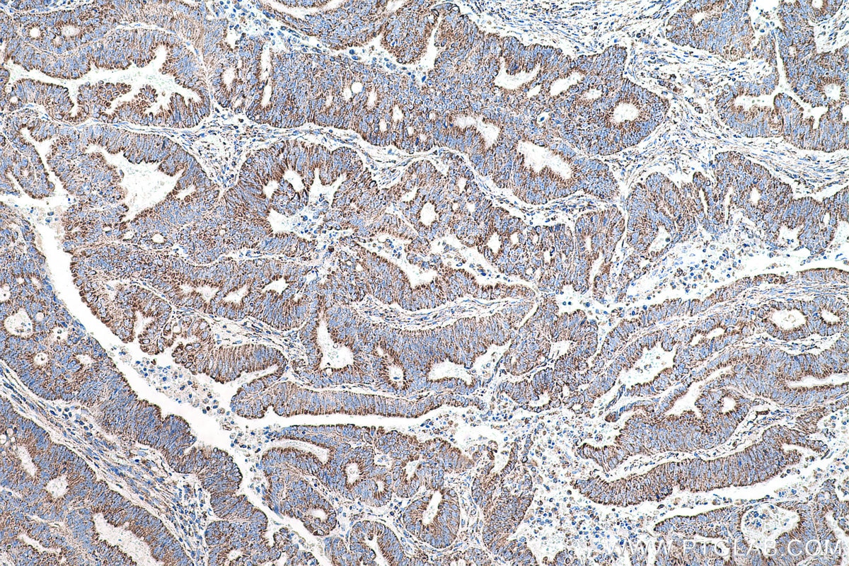 Immunohistochemistry (IHC) staining of human colon cancer tissue using MTCO2 Polyclonal antibody (55070-1-AP)
