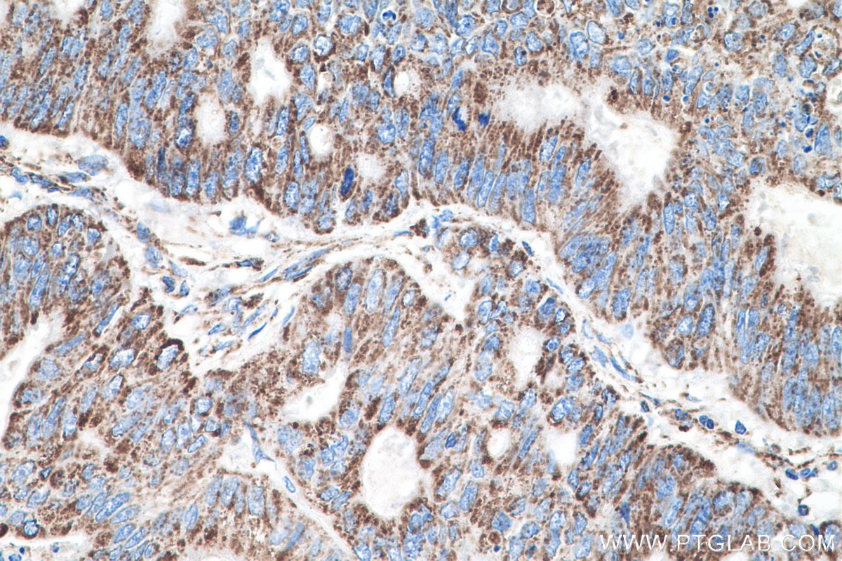 Immunohistochemistry (IHC) staining of human colon cancer tissue using MTCO2 Polyclonal antibody (55070-1-AP)