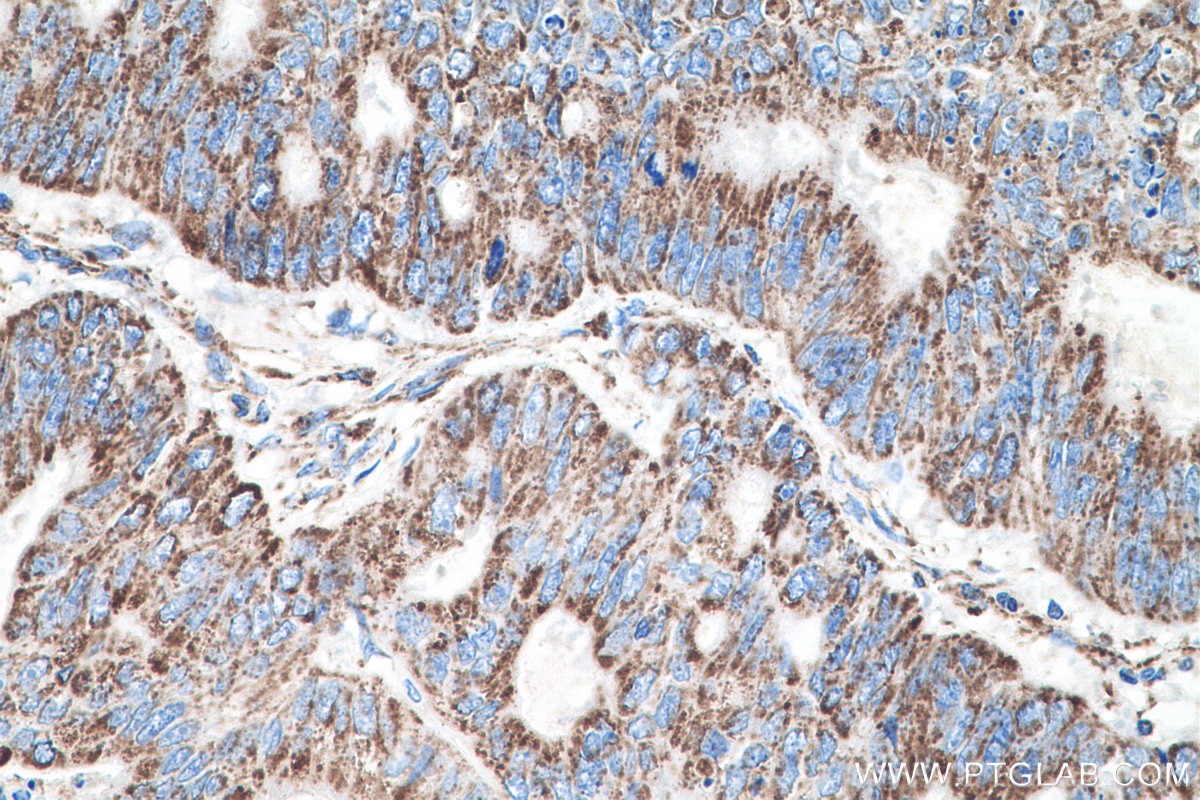 IHC staining of human colon cancer using 55070-1-AP