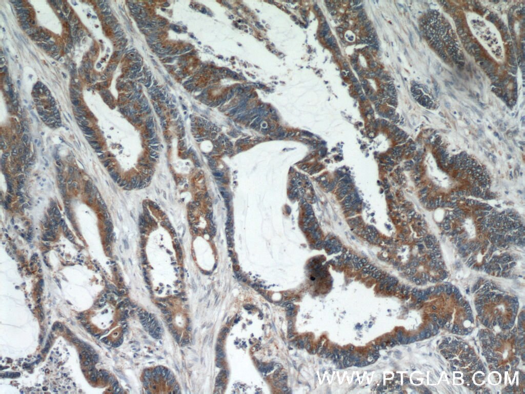 IHC staining of human colon cancer using 55070-1-AP