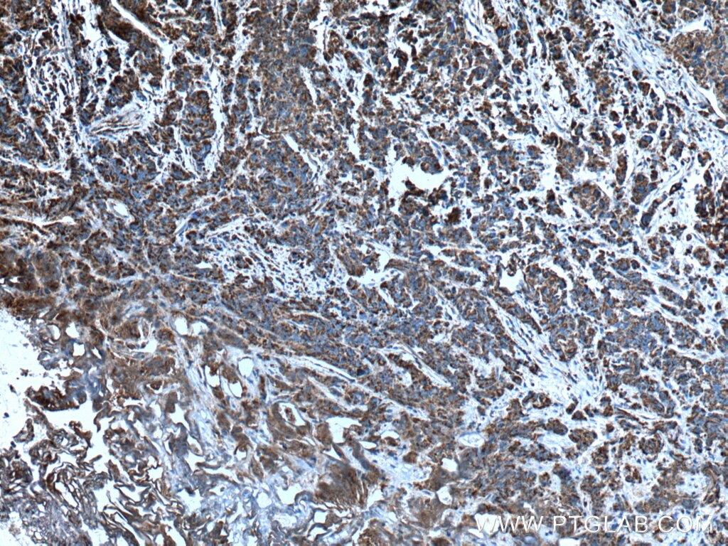 Immunohistochemistry (IHC) staining of human prostate cancer tissue using COXIV Polyclonal antibody (11242-1-AP)