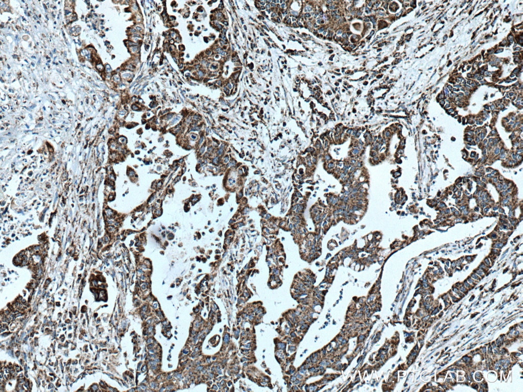 Immunohistochemistry (IHC) staining of human pancreas cancer tissue using COXIV Polyclonal antibody (11242-1-AP)