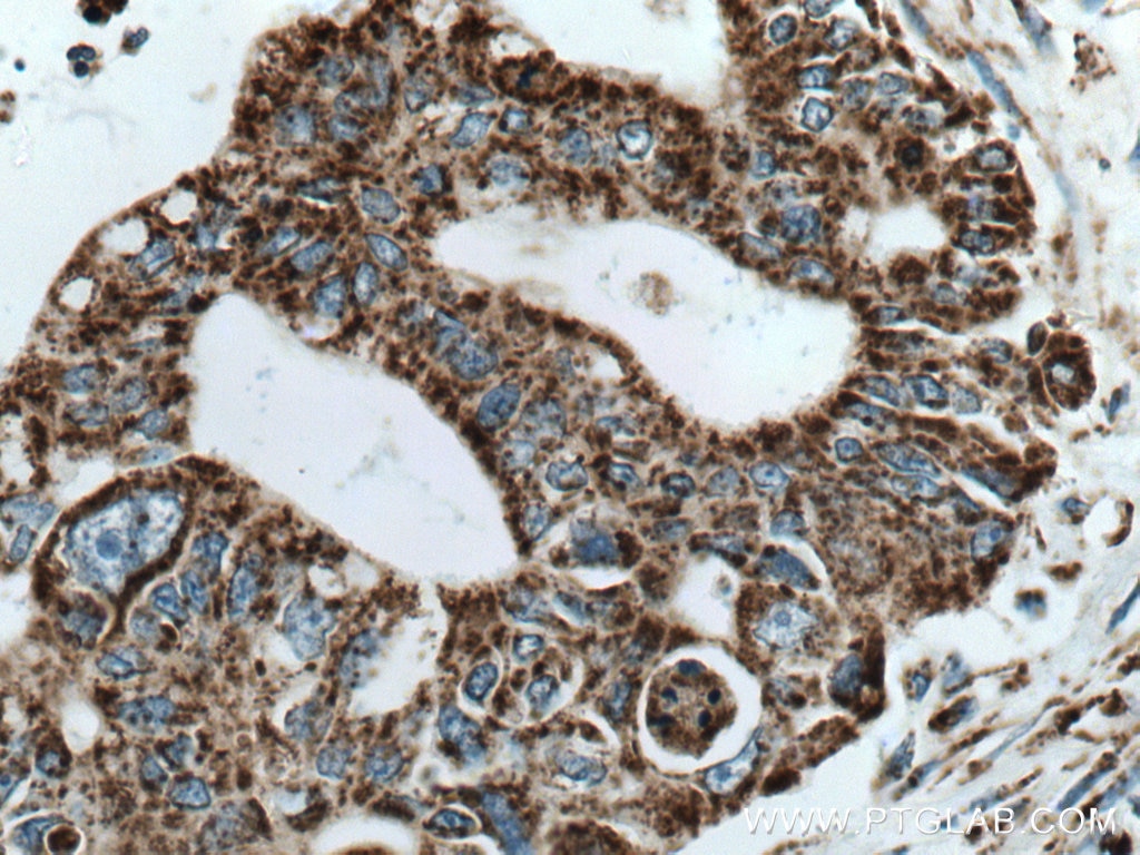 Immunohistochemistry (IHC) staining of human pancreas cancer tissue using COXIV Polyclonal antibody (11242-1-AP)