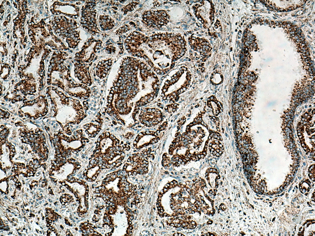 Immunohistochemistry (IHC) staining of human prostate cancer tissue using COXIV Polyclonal antibody (11242-1-AP)