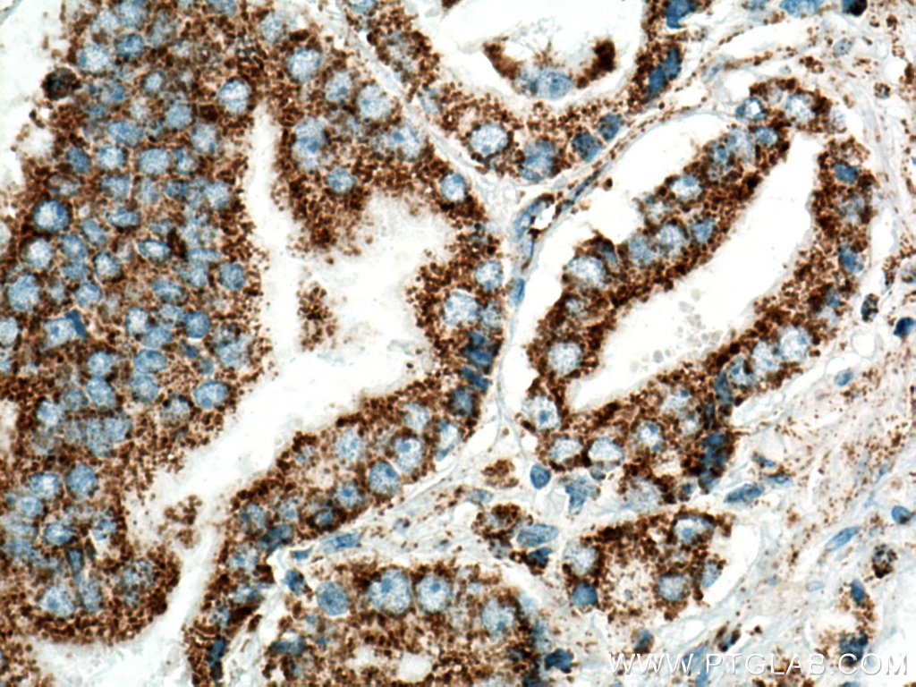 Immunohistochemistry (IHC) staining of human prostate cancer tissue using COXIV Polyclonal antibody (11242-1-AP)