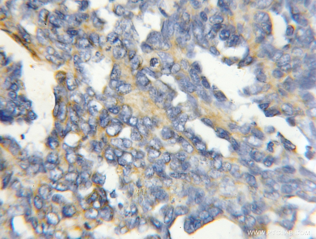 Immunohistochemistry (IHC) staining of human ovary tumor tissue using COX4I2 Polyclonal antibody (11463-1-AP)