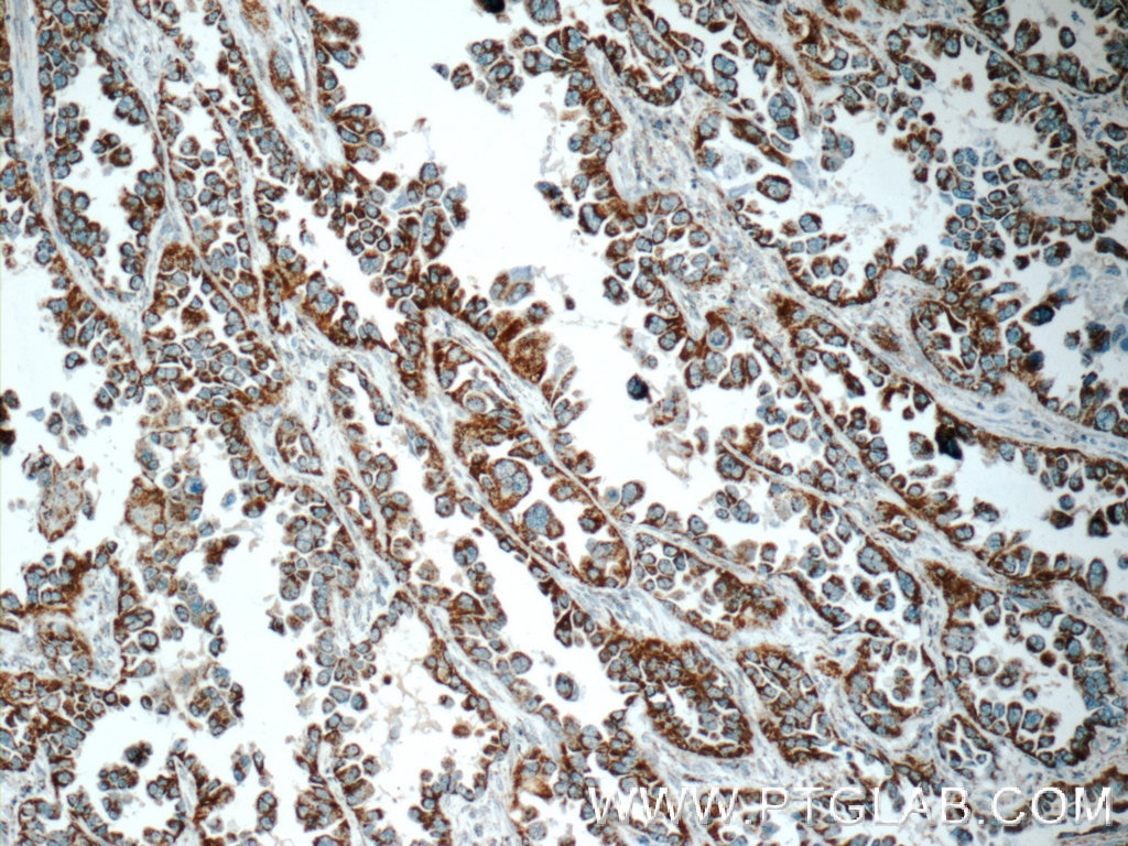 Immunohistochemistry (IHC) staining of human lung cancer tissue using COX5A Polyclonal antibody (11448-1-AP)