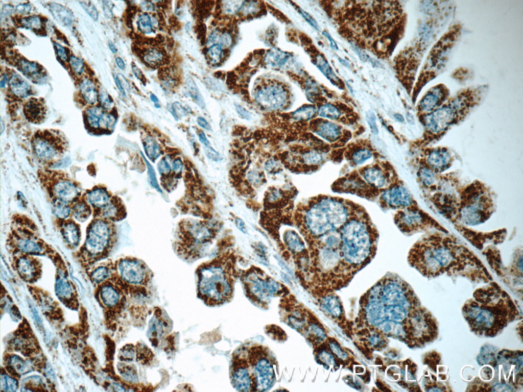 Immunohistochemistry (IHC) staining of human lung cancer tissue using COX5A Polyclonal antibody (11448-1-AP)