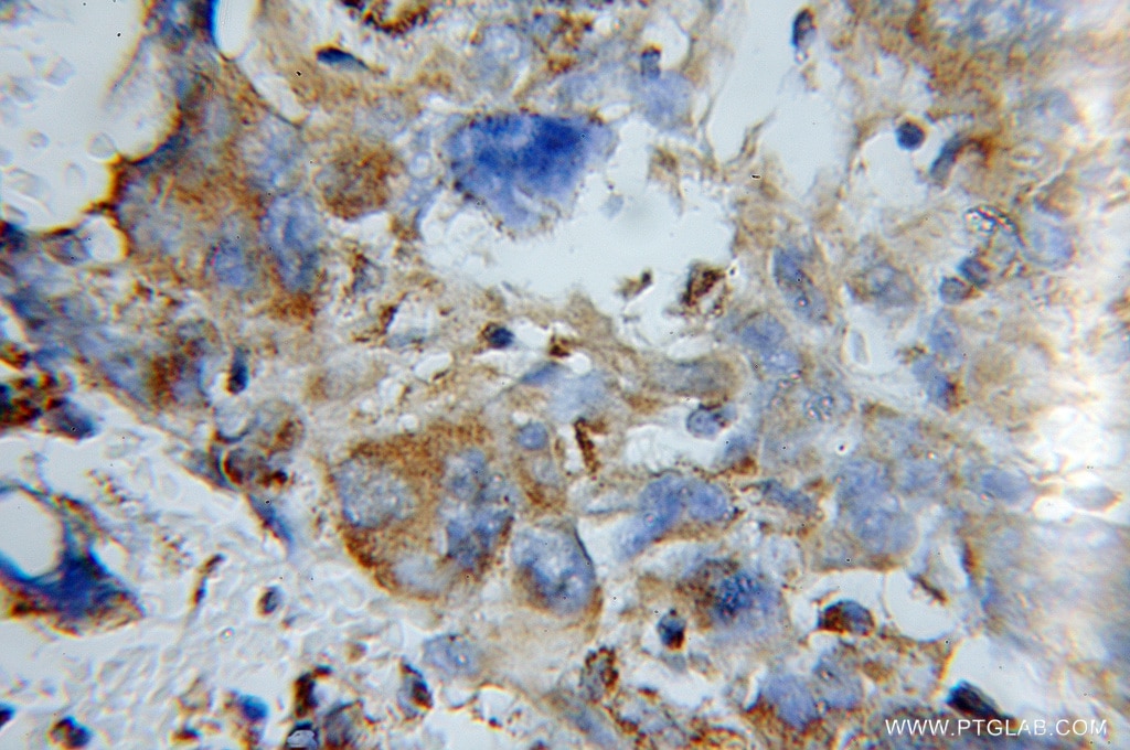 Immunohistochemistry (IHC) staining of human gliomas tissue using COX5A Polyclonal antibody (11448-1-AP)