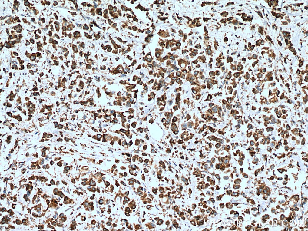 Immunohistochemistry (IHC) staining of human breast cancer tissue using COX5B Polyclonal antibody (11418-2-AP)