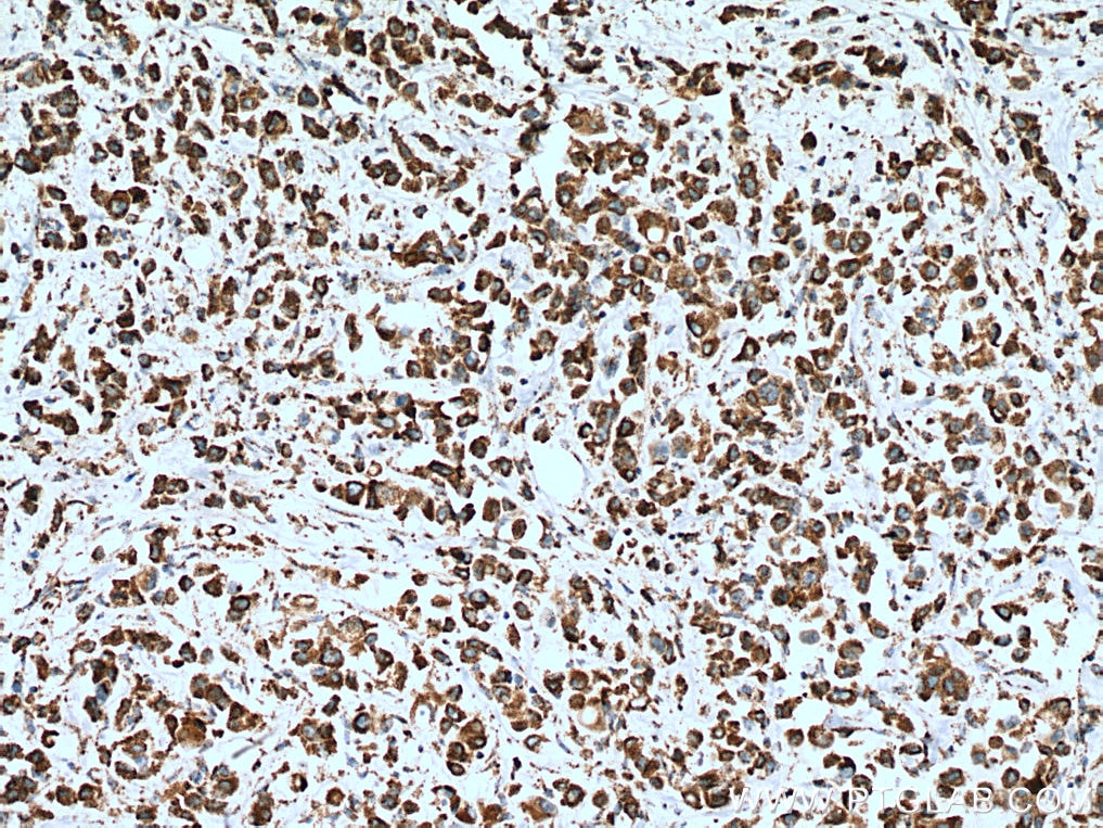 IHC staining of human breast cancer using 11418-2-AP