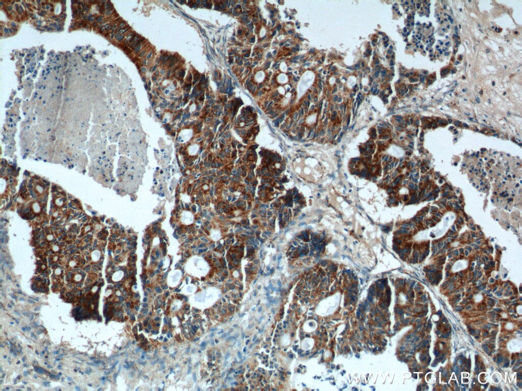 Immunohistochemistry (IHC) staining of human pancreas cancer tissue using COX6A1 Polyclonal antibody (11460-1-AP)