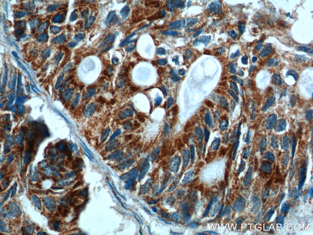 IHC staining of human pancreas cancer using 11460-1-AP