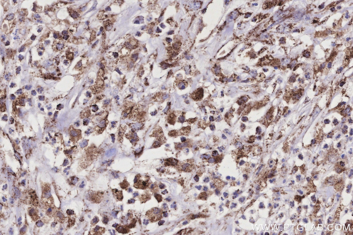 Immunohistochemistry (IHC) staining of human colon cancer tissue using COX6A1 Polyclonal antibody (11460-1-AP)