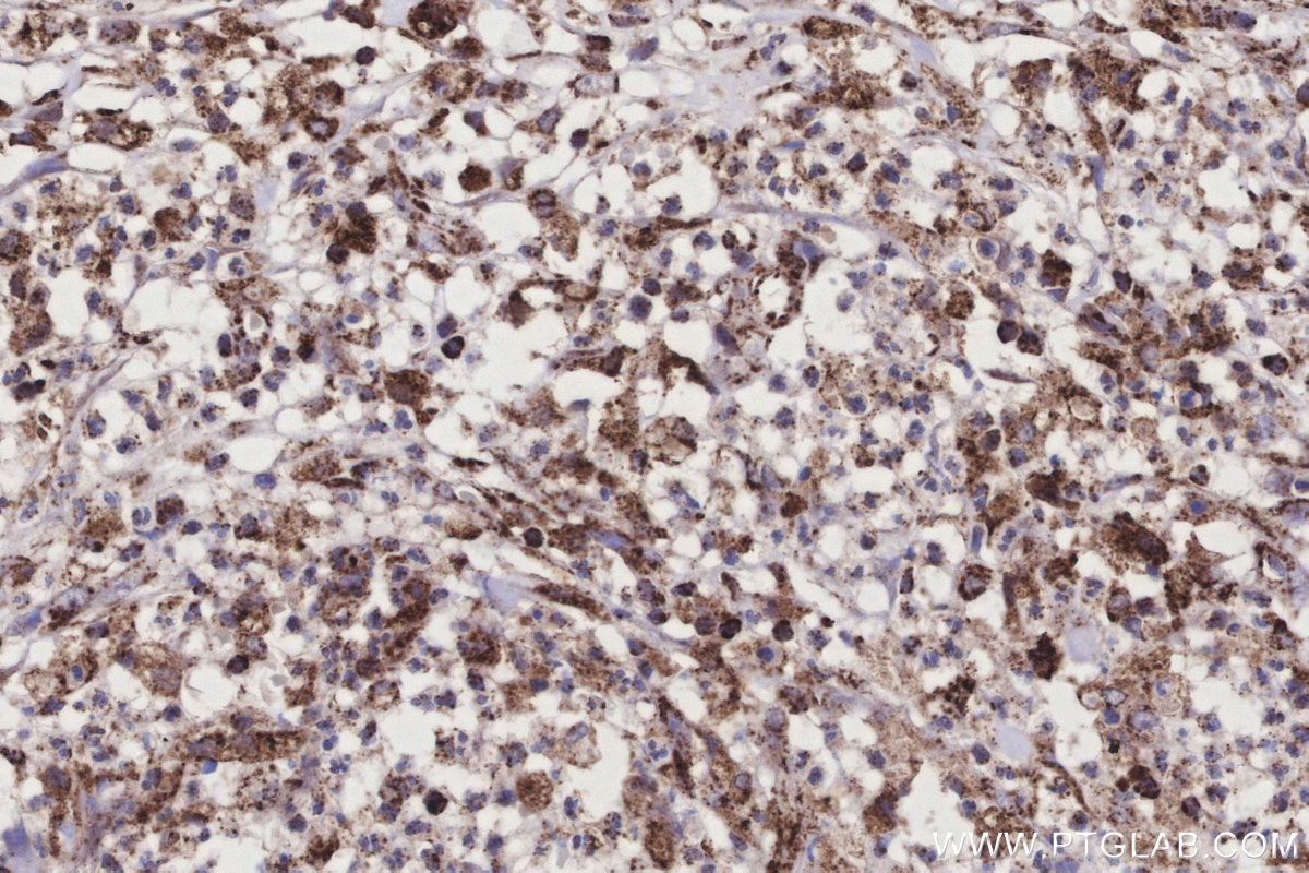 Immunohistochemistry (IHC) staining of human colon cancer tissue using COX6A1 Polyclonal antibody (11460-1-AP)