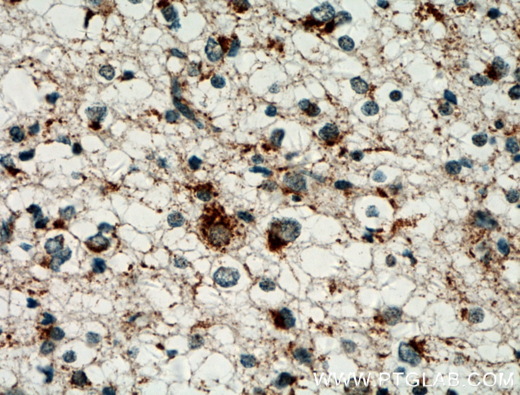 IHC staining of human gliomas using 11425-1-AP
