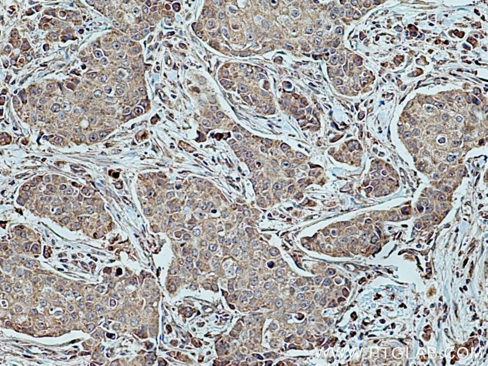 Immunohistochemistry (IHC) staining of human breast cancer tissue using COX6B1 Polyclonal antibody (11425-1-AP)