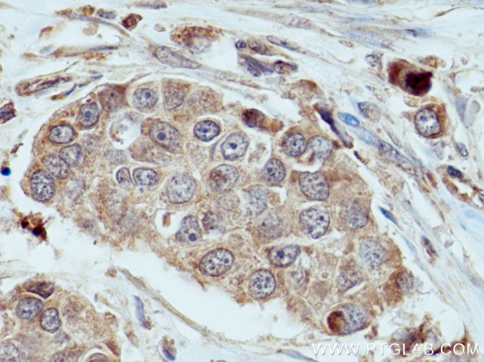 IHC staining of human breast cancer using 11425-1-AP