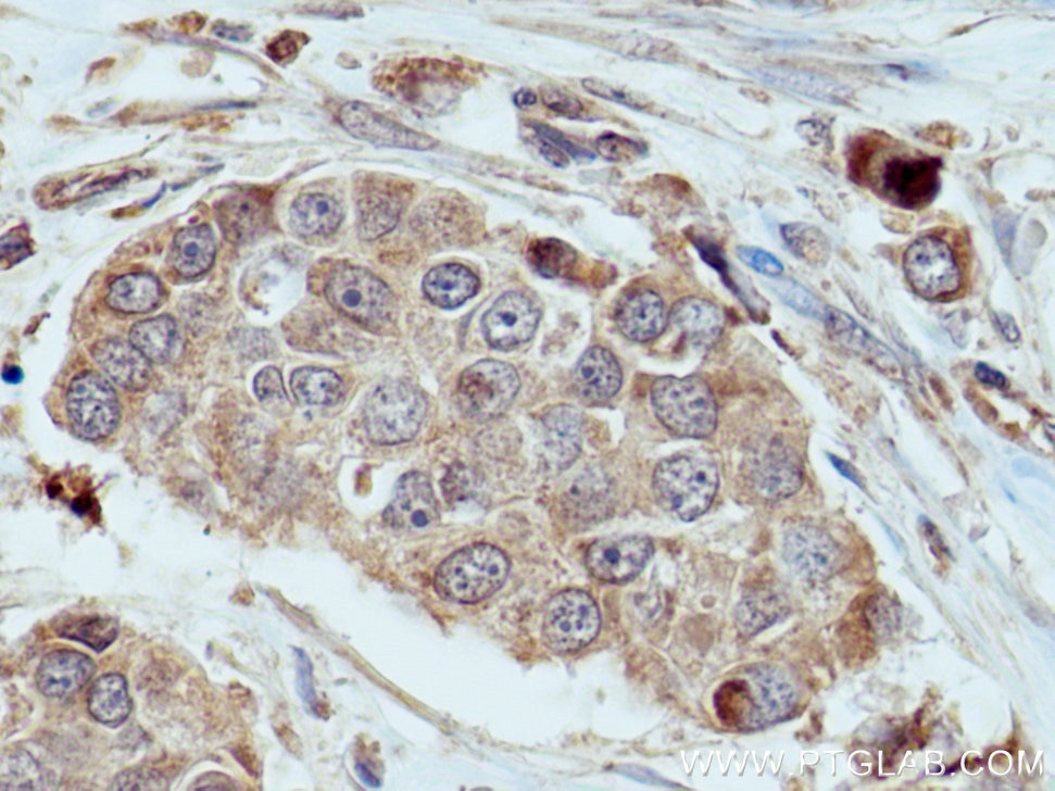 Immunohistochemistry (IHC) staining of human breast cancer tissue using COX6B1 Polyclonal antibody (11425-1-AP)