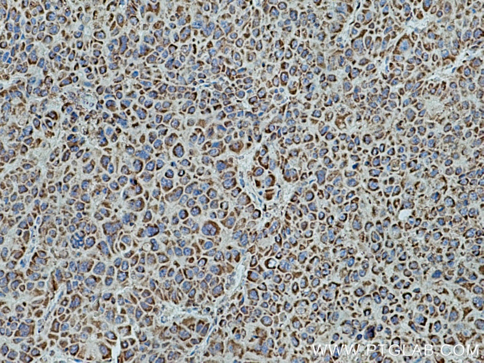 Immunohistochemistry (IHC) staining of human liver cancer tissue using COX6B1 Polyclonal antibody (11425-1-AP)