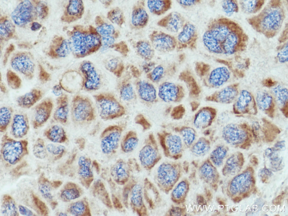 Immunohistochemistry (IHC) staining of human liver cancer tissue using COX6B1 Polyclonal antibody (11425-1-AP)