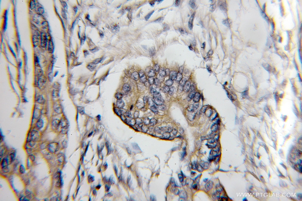 Immunohistochemistry (IHC) staining of human pancreas cancer tissue using COX6C Polyclonal antibody (11429-2-AP)