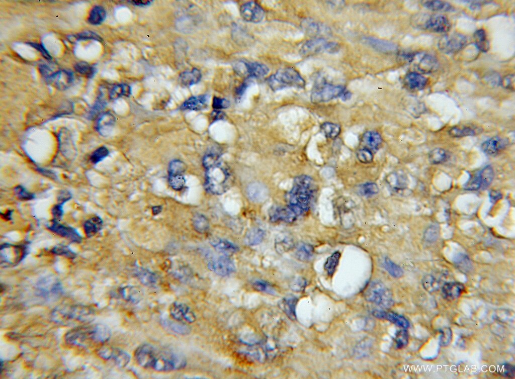 Immunohistochemistry (IHC) staining of human gliomas tissue using COX7A1 Polyclonal antibody (11413-1-AP)