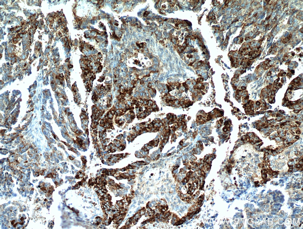 Immunohistochemistry (IHC) staining of human ovary tumor tissue using COX7A2L Polyclonal antibody (11416-1-AP)