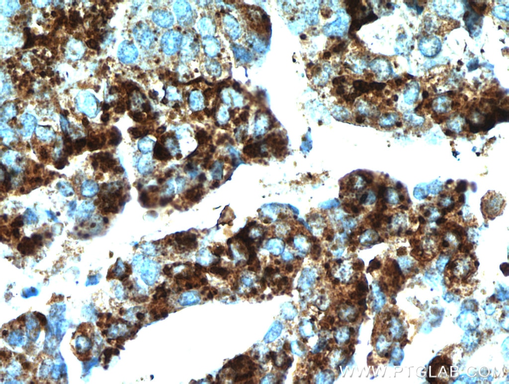 IHC staining of human ovary tumor using 11416-1-AP