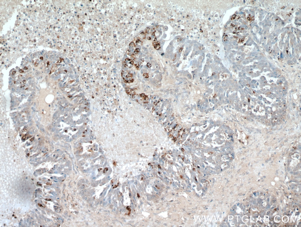 Immunohistochemistry (IHC) staining of human ovary tumor tissue using COX7A2L Polyclonal antibody (11416-1-AP)