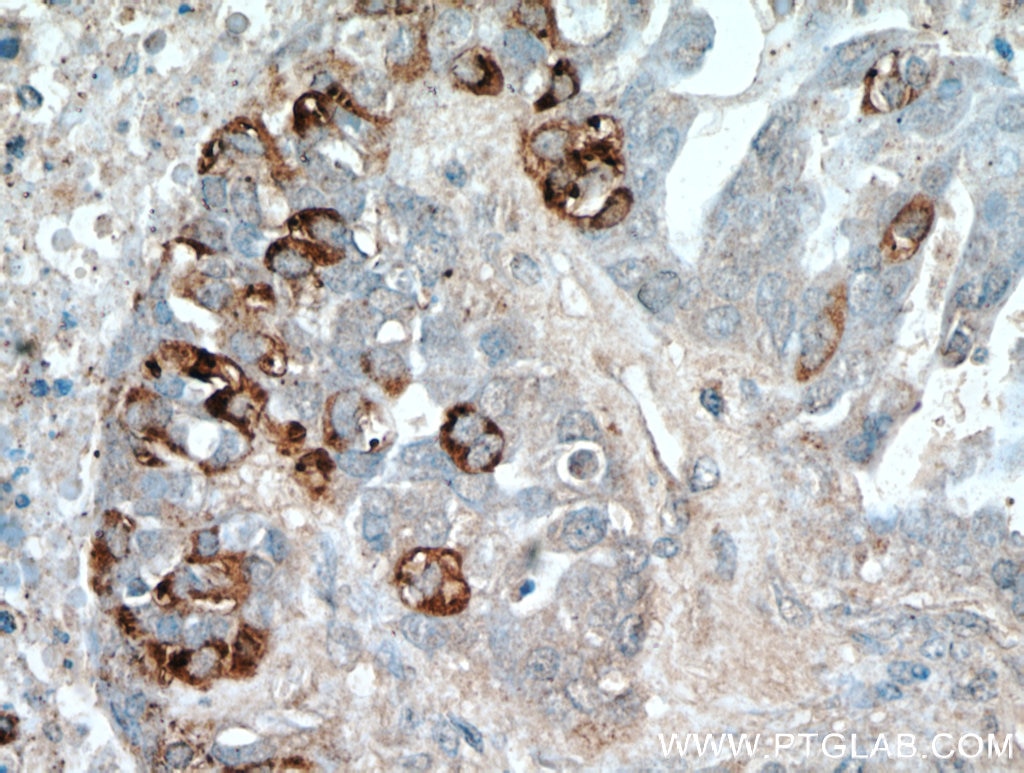 IHC staining of human ovary tumor using 11416-1-AP