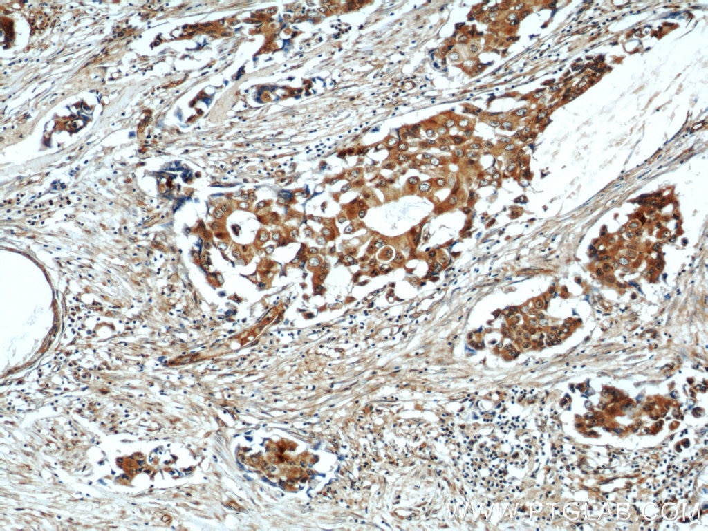 Immunohistochemistry (IHC) staining of human breast cancer tissue using COX7A2L Polyclonal antibody (11416-1-AP)