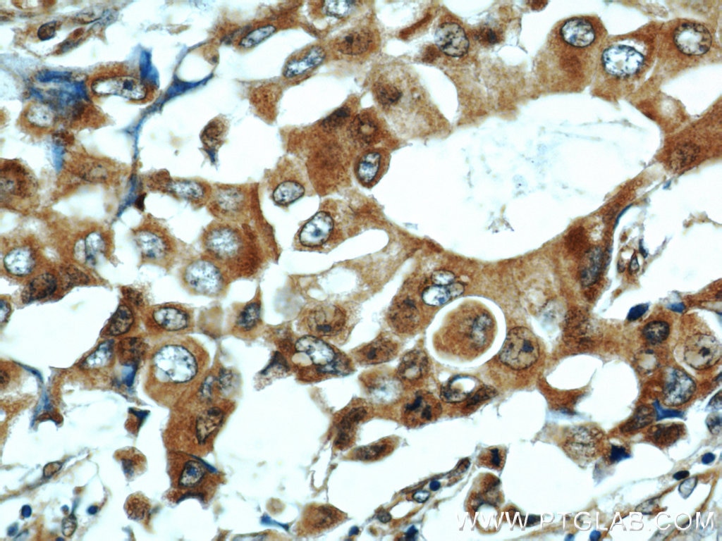 Immunohistochemistry (IHC) staining of human breast cancer tissue using COX7A2L Polyclonal antibody (11416-1-AP)