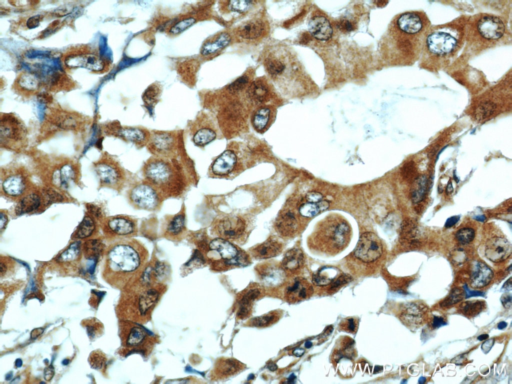 IHC staining of human breast cancer using 11416-1-AP