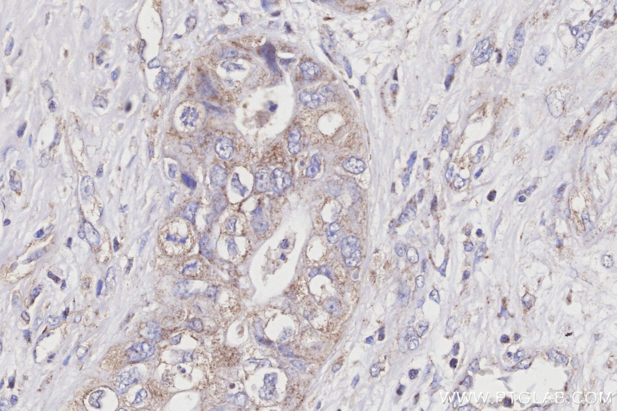 Immunohistochemistry (IHC) staining of human pancreas cancer tissue using COX7C Polyclonal antibody (11411-2-AP)