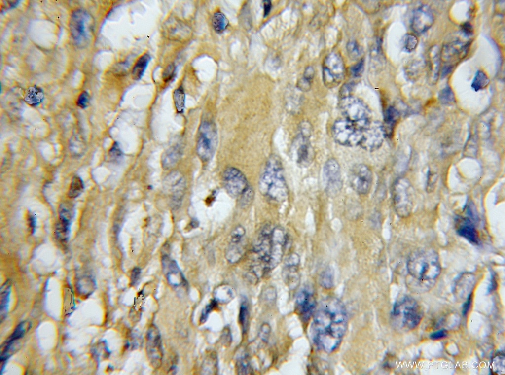 Immunohistochemistry (IHC) staining of human gliomas tissue using COX7C Polyclonal antibody (11411-2-AP)