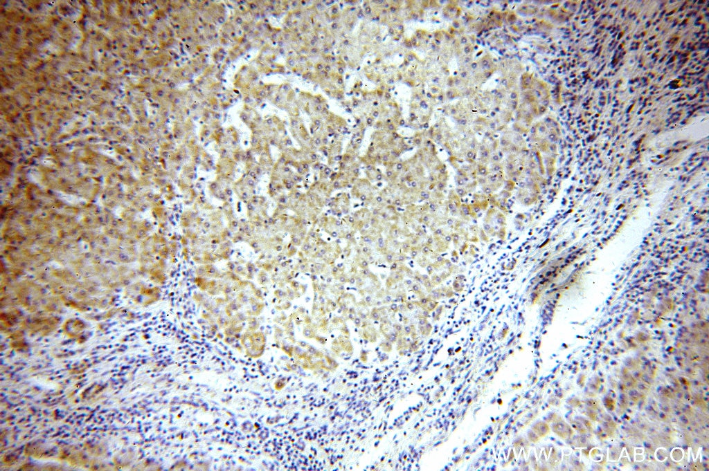 Immunohistochemistry (IHC) staining of human hepatocirrhosis tissue using COX8A Polyclonal antibody (15368-1-AP)