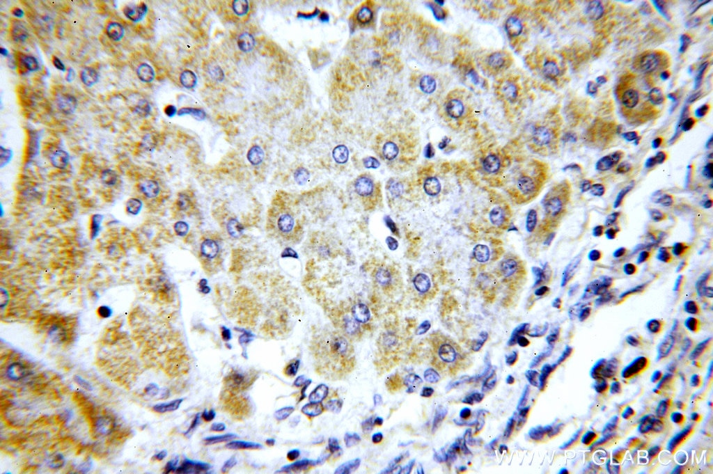 Immunohistochemistry (IHC) staining of human hepatocirrhosis tissue using COX8A Polyclonal antibody (15368-1-AP)