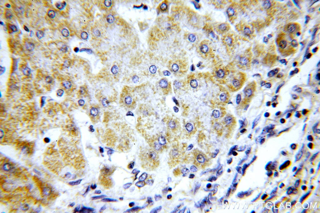 IHC staining of human hepatocirrhosis using 15368-1-AP