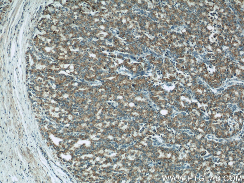 Immunohistochemistry (IHC) staining of human prostate cancer tissue using COXIV Monoclonal antibody (60251-1-Ig)