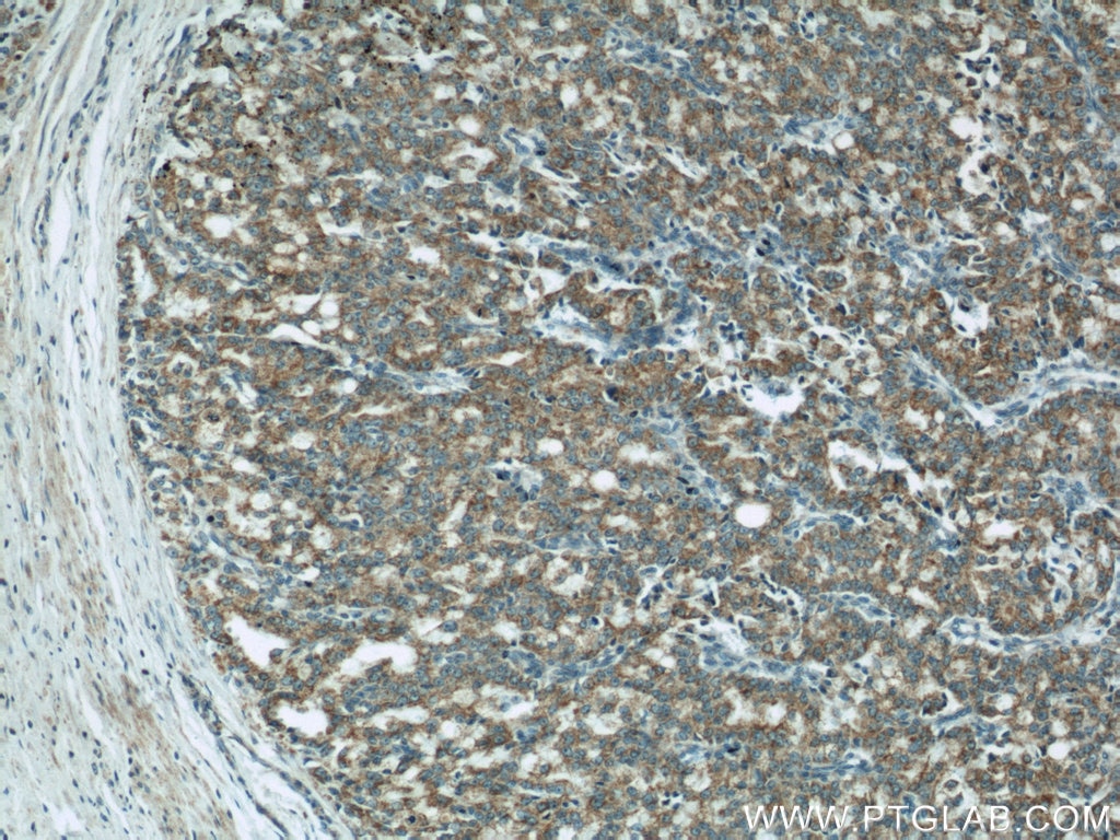 IHC staining of human prostate cancer using 60251-1-Ig